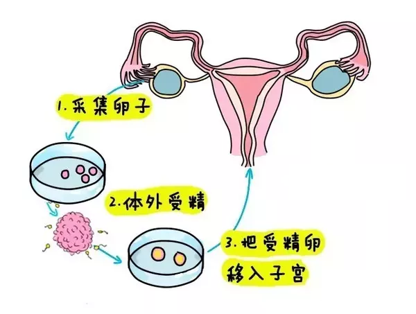 女性取卵